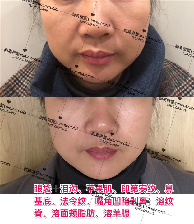 嘴角凹陷剥离 