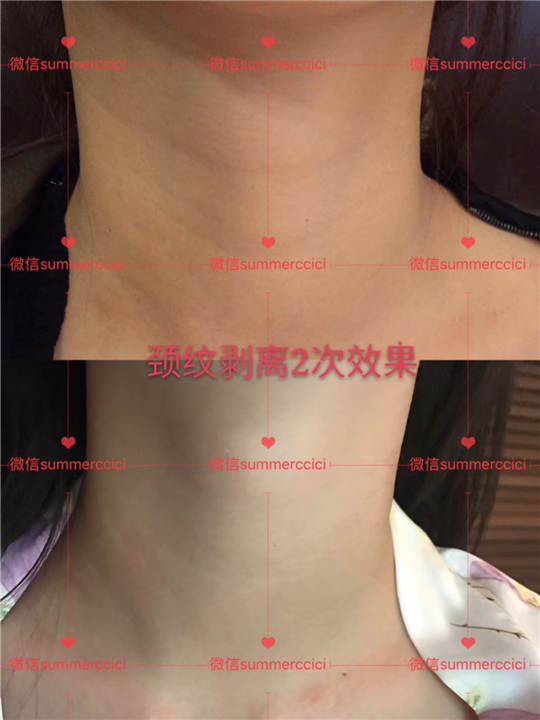 颈纹剥离2次效果 