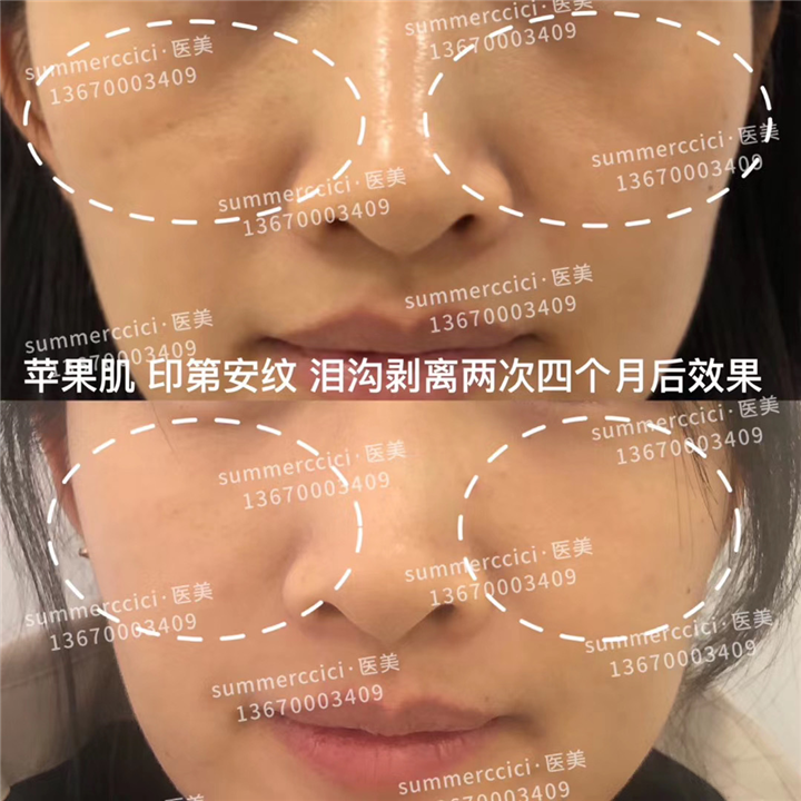 印第安纹剥离4个月后效果 