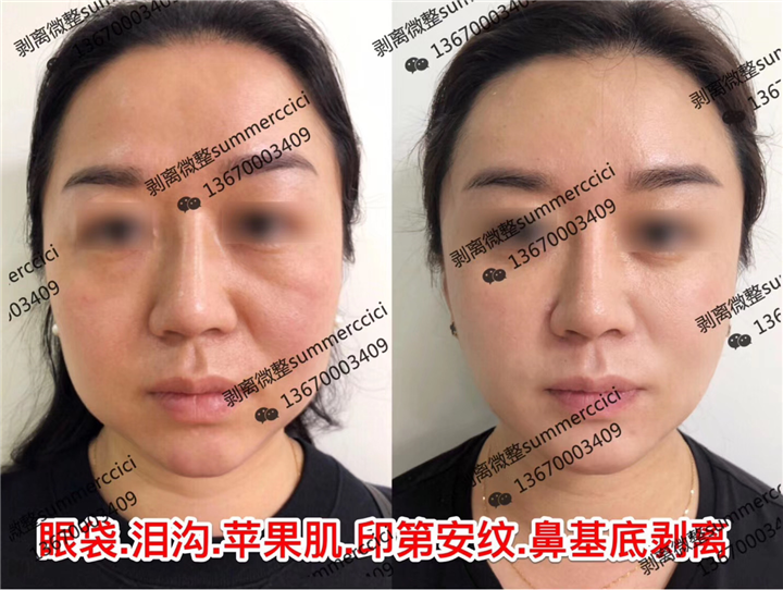 印第安纹剥离1年后效果 