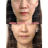 印第安纹剥离三次后效果 