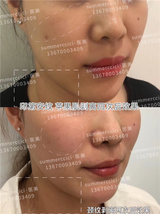 印第安纹剥离4次后效果 