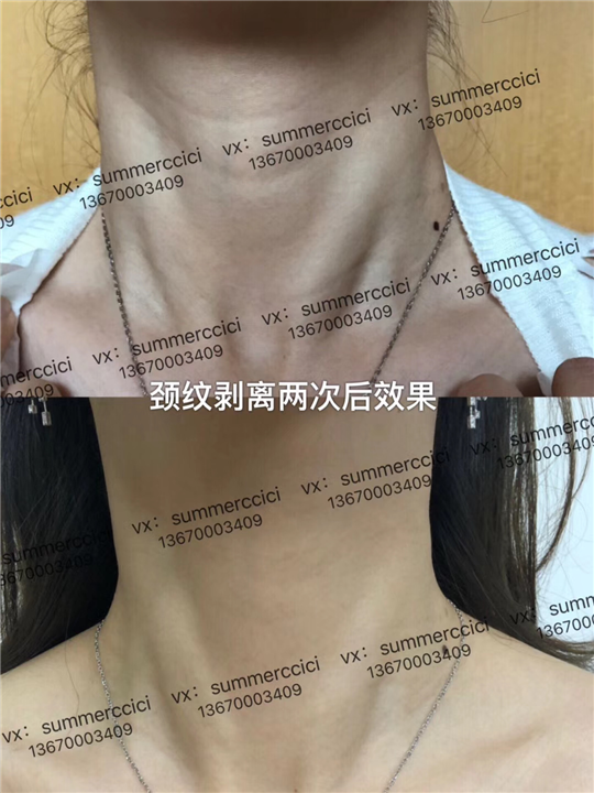 颈纹剥离2次后 