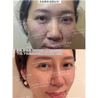 印第安纹剥离3年后 