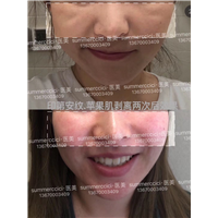 印第安纹剥离2次后 