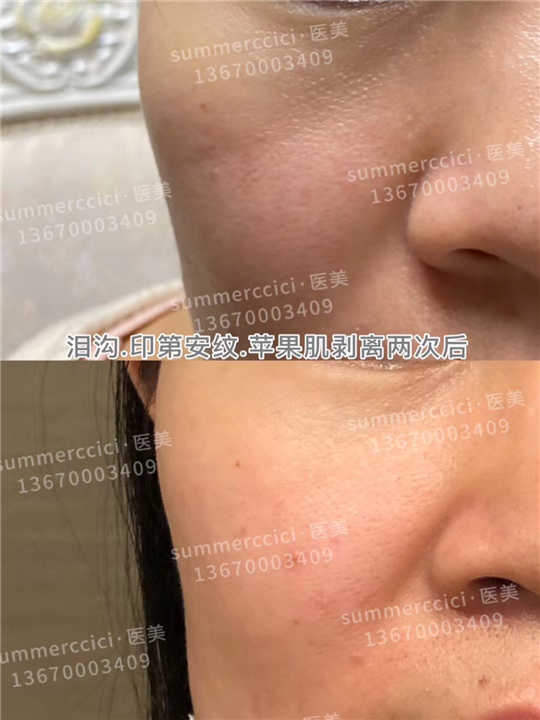 印第安纹剥离2次后效果 