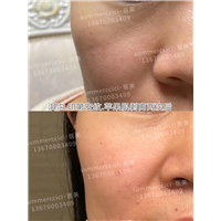 印第安纹剥离2次后效果 