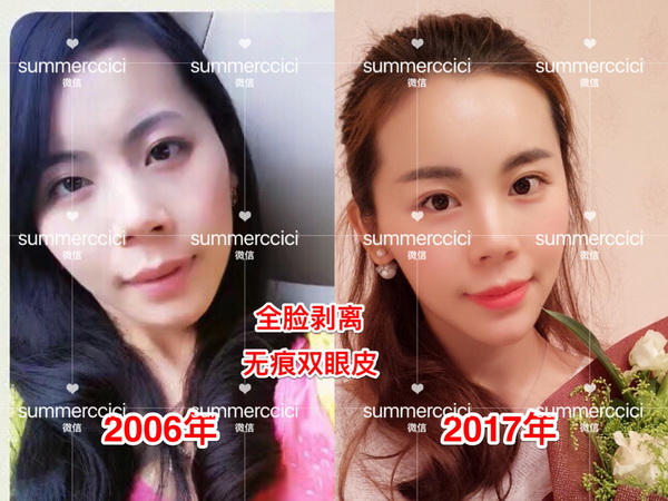 印第安纹|印第安纹怎么改善
