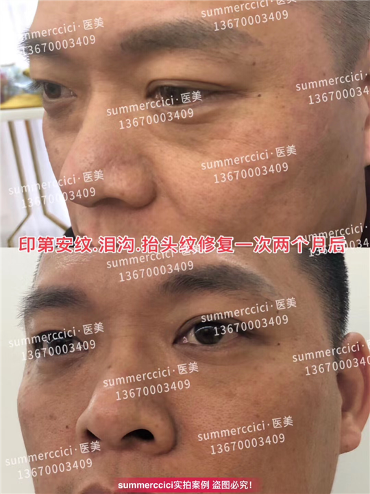 印第安纹剥离1次后的效果 