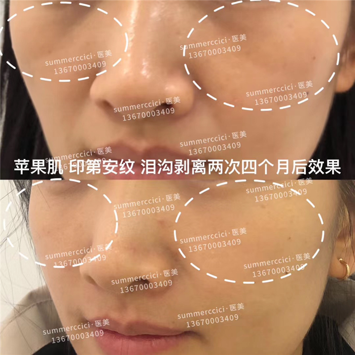 印第安纹剥离2次后 