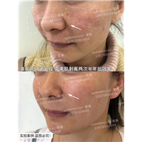 印第安纹剥离2次后 