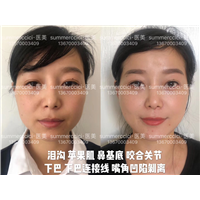 鼻基底剥离1年多效果 