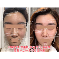 印第安纹苹果肌剥离1次后效果 