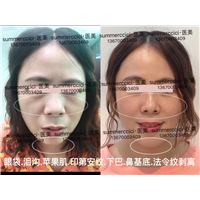 鼻基底剥离7个月 