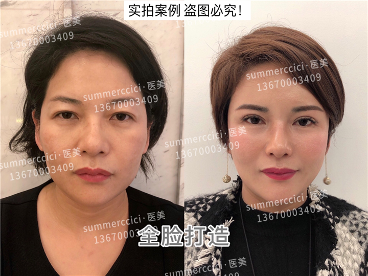 全脸剥离1年多 