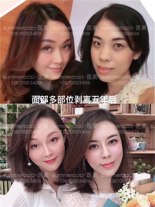 全脸剥离8年效果 