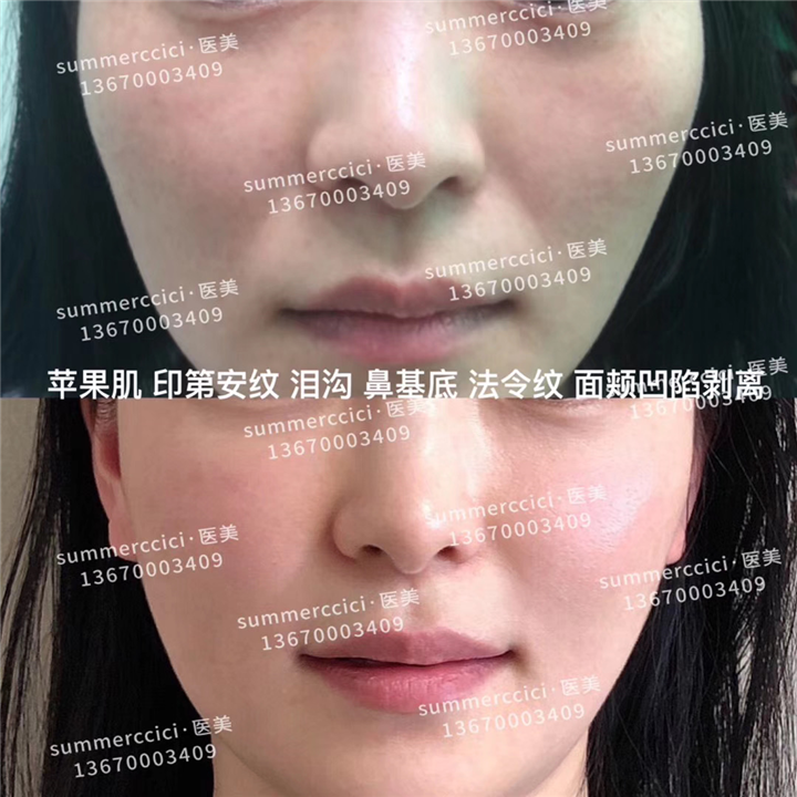 面颊凹陷剥离后 