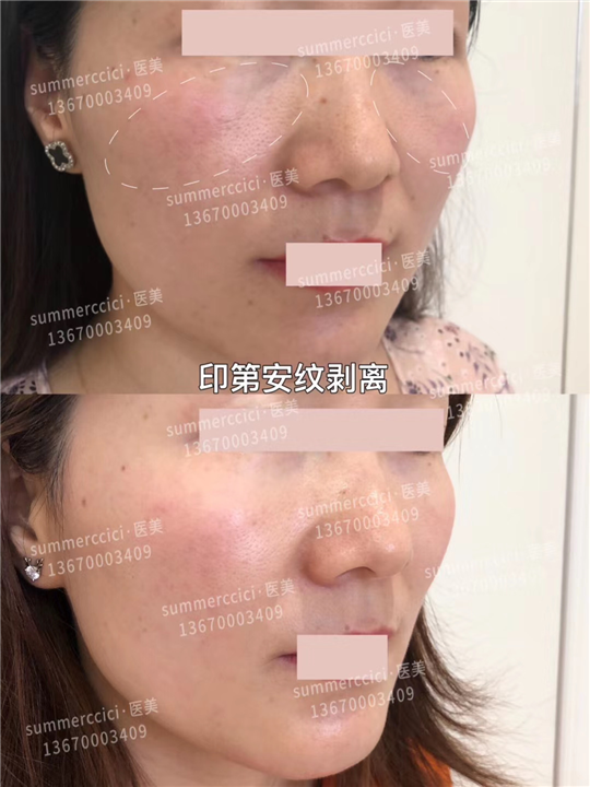 印第安纹剥离效果 