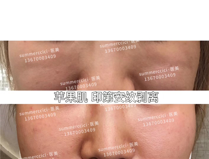 印第安纹苹果肌 