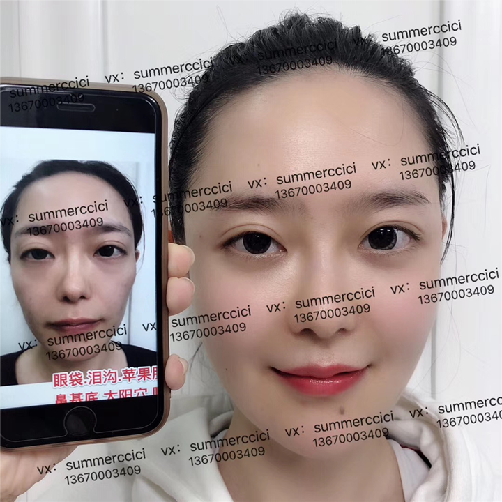 全脸剥离8个月后 