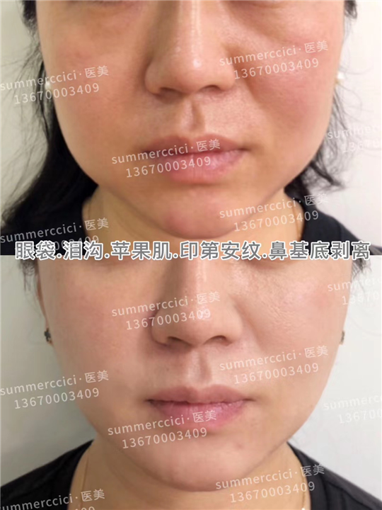印第安纹剥离1年后效果 