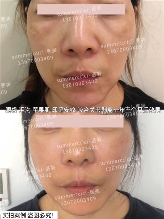 印第安纹苹果肌泪沟剥离一年多效果 