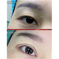 广州眼综合整形专家
