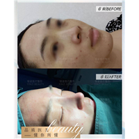 广州鼻整形专家朱正道院长