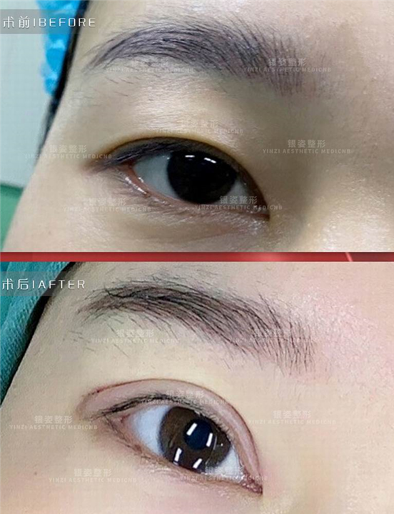 广州眼综合整形专家