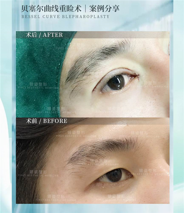 广州眼部整形专家