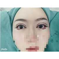 广州眼部整形专家