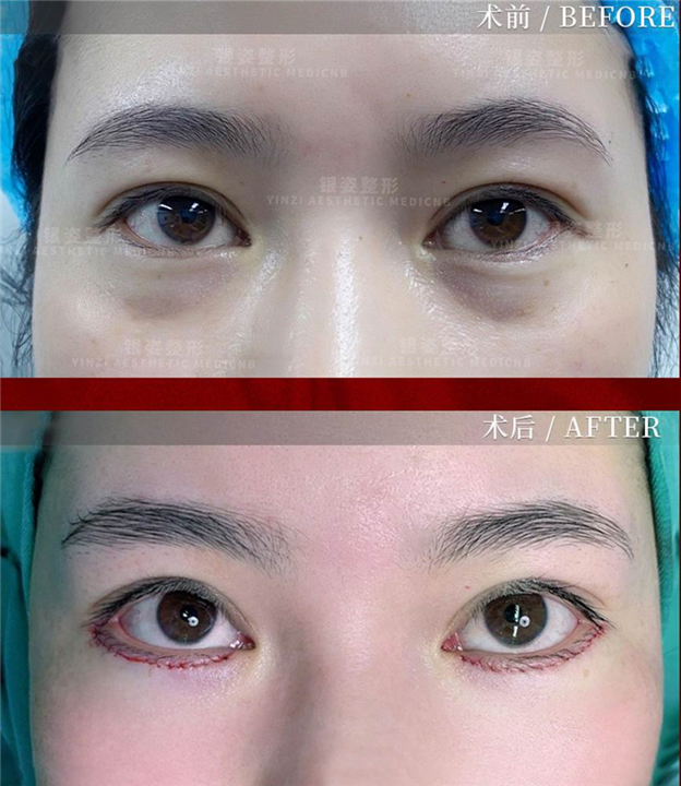 广州眼综合整形专家