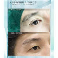 广州眼部整形专家