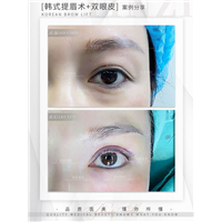 广州眼部整形专家