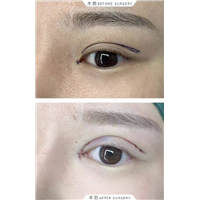 广州眼部整形专家