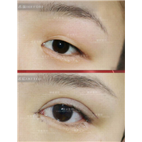 广州眼综合整形专家