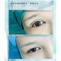 广州眼部整形专家