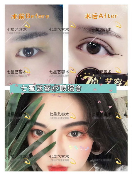 上海肋骨隆鼻整形|上海做眼综合哪家好