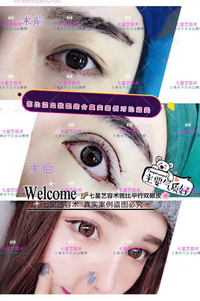 上海肋骨隆鼻整形|上海做眼综合哪家好