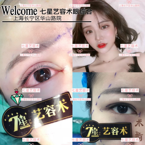 上海肋骨隆鼻整形|上海做眼综合哪家好