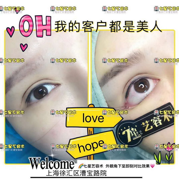 上海肋骨隆鼻整形|上海做眼综合哪家好