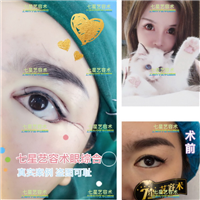 上海**网红整形|上海肋骨隆鼻整形