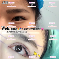 上海**网红整形|上海肋骨隆鼻整形