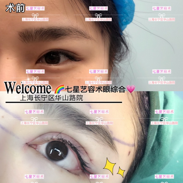 上海**网红整形|上海肋骨隆鼻整形