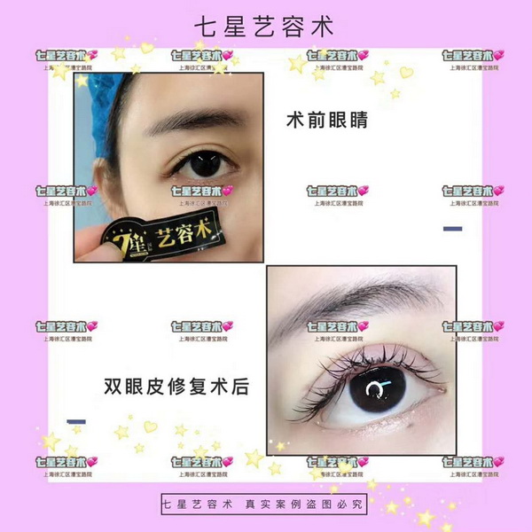 上海网红全脸打造手术