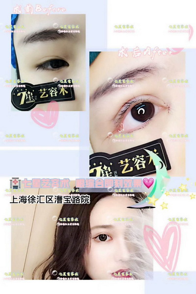 上海做大腿抽脂手术哪家好