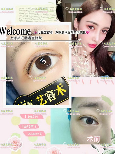 上海网红全脸打造手术