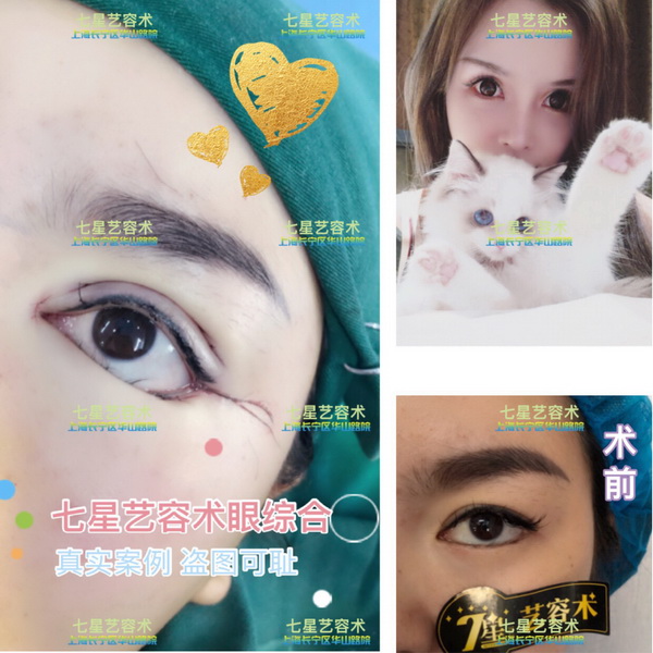 上海**网红整形|上海肋骨隆鼻整形