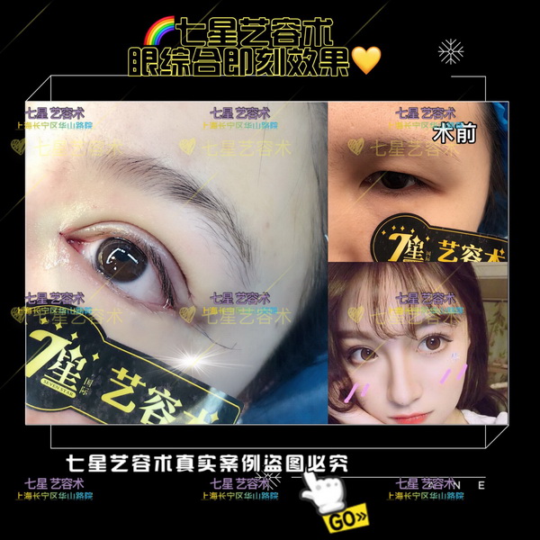 上海**网红整形|上海肋骨隆鼻整形
