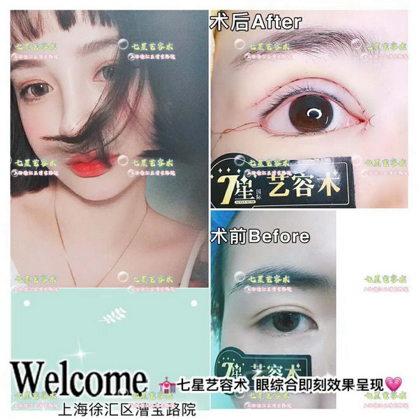 上海做大腿抽脂手术哪家好